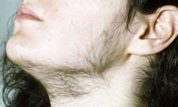 Cường androgen ở phụ nữ có biểu hiện gì?