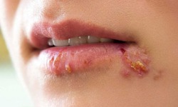 Vì sao zona thường tái phát và gây đau kéo dài?