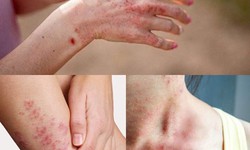 Thuốc điều trị vi&#234;m da trong m&#249;a mưa