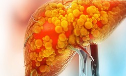 
5 bước quan trọng ph&#242;ng ngừa biến chứng gan nhiễm mỡ kh&#244;ng do rượu 