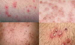 Điều trị vi&#234;m nang l&#244;ng bằng thuốc - Khi n&#224;o cần sử dụng?
