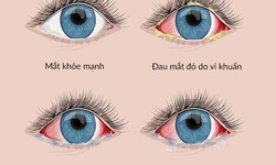 Đau mắt đỏ - Thuốc trị theo nguyên nhân và những biện pháp hỗ trợ không dùng thuốc