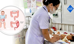 Cứu sống trẻ sinh non bị vi&#234;m ruột hoại tử
