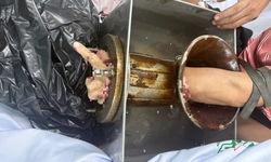 Bị máy xay thịt cuốn tay, nam công nhân bị cắt cụt tới 1/3 trên cẳng tay