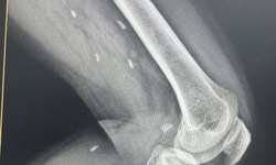 
Phát hiện nhiều kén sán ở chân bệnh nhân do một thói quen thường gặp