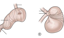 Xoắn dạ dày ở trẻ em rất nguy hiểm, cha mẹ cần phát hiện sớm