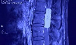 Hạnh phúc nghẹn ngào của người mẹ trẻ sau ca vi phẫu loại bỏ khối u tủy gần 10cm