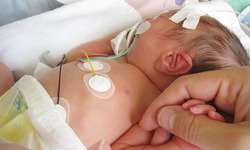 Trẻ mắc bệnh tim bẩm sinh có tím cần phát hiện và điều trị sớm