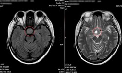 Nhìn mờ kéo dài, người phụ nữ phát hiện u tuyến yên nhờ khám mắt