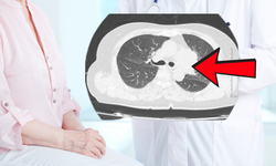 Không có triệu chứng hô hấp, người phụ nữ 40 tuổi vẫn phát hiện ung thư phổi