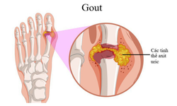 Vì sao người trẻ có thể mắc gout?