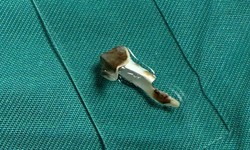Bé 13 tuổi ho kéo dài hơn 3 năm, bác sĩ phát hiện dị vật nhựa trong phế quản