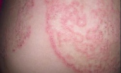 5 nguyên tắc quan trọng giúp phòng ngừa nấm da