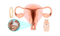 Vùng kín ngứa ngáy, đừng vội đặt thuốc nếu chưa biết điều này