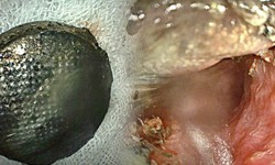 Trẻ bị tổn thương nghiêm trọng thực quản vì pin cúc áo, bác sĩ khuyến cáo