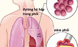 5 cách giúp chủ động phòng ngừa viêm phổi khi chuyển mùa