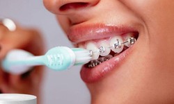 Vệ sinh răng miệng khi niềng răng như thế nào?