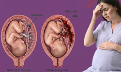 Nhau bong non nguy hiểm như thế nào?