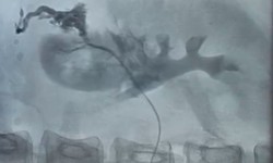 Bệnh viện 19-8 cấp cứu ca vỡ thận nguy kịch