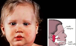 Bệnh quai bị bao lâu thì khỏi?