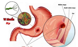 Tập luyện thể chất: Giải pháp không mất tiền phòng ngừa và hỗ trợ điều trị viêm loét dạ dày- tá tràng