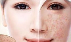 Nhận diện thủ phạm gây đốm đồi mồi trên da
