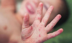 Lâm Đồng giám sát người tiếp xúc gần sau ca bệnh viêm màng não mô cầu