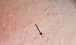 Viêm nang lông có tự khỏi không?