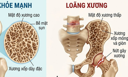 Phòng loãng xương cần hạn chế 5 loại thực phẩm này