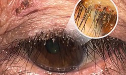 Phát hiện ổ rận mu bám dày trên mí mắt người phụ nữ