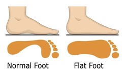 Bàn chân bẹt ở trẻ em có cần điều trị không?