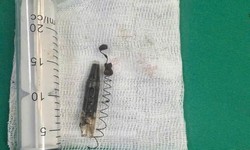 Phẫu thuật lấy dị vật lò xo bút bi 'ngủ quên' 13 năm trong vùng thái dương