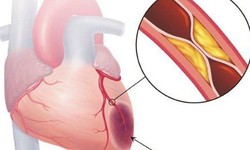 Dùng thuốc đúng cách giúp kiểm soát mỡ máu cao, phòng ngừa biến chứng tim mạch