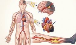 Những biến chứng nguy hiểm khi không kiểm soát mỡ máu