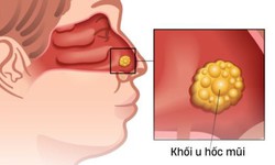 Nghẹt mũi kéo dài cảnh giác với ung thư hốc mũi