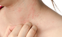 Xử trí đúng cách bệnh da do côn trùng  
