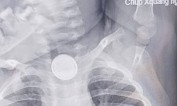 Nuốt pin cúc áo, bé 2 tuổi bỏng nặng thực quản