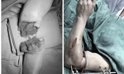 Hồi sinh cánh tay đứt lìa dập nát trong 'giờ vàng'