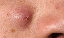 Mụn bọc trên mặt dễ biến chứng nếu tự ý nặn mụn