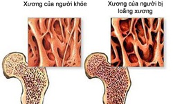 5 giải pháp đơn giản giúp duy trì xương chắc khỏe sau tuổi 50