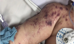 Đã có 4 ca tử vong do não mô cầu, cần biết 4 khuyến cáo phòng bệnh của Bộ Y tế