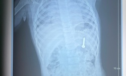 Bé 21 tháng tuổi nuốt phải đinh vít dài khoảng 2,5cm