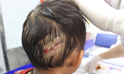 Bé 4 tuổi bị chó nhà cắn, nhiều vết thương nặng ở đầu và tay