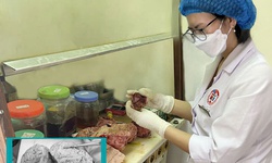 Người phụ nữ 46 tuổi mang trong mình khối u tử cung khổng lồ nặng 5kg