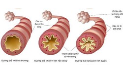 Bệnh hen có lây không?