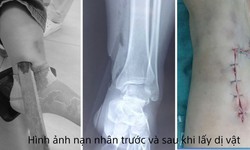 Một phụ nữ bị dị vật cắm sâu vào cẳng chân sau tai nạn giao thông