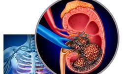 Đau vùng hông lưng, người phụ nữ phát hiện khối u thận 