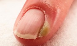 Chín mé ngón tay xử trí ra sao?