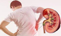 Sỏi thận có thể tự đào thải trong bao lâu, khi nào cần can thiệp?