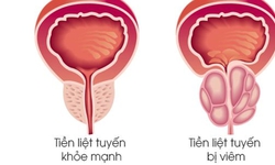 Viêm tuyến tiền liệt có dễ phát hiện không?